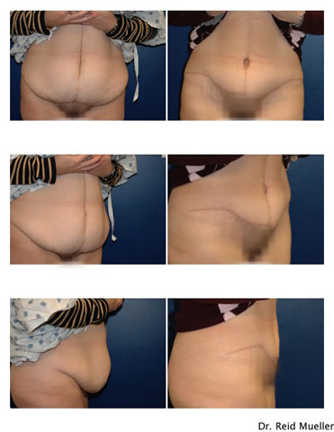 Hysterectomy Scars Pictures Hysterectomy Scars Pictures