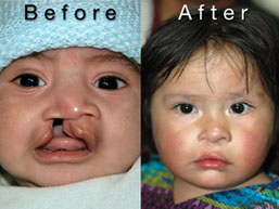 Before and after of Guatemalan child with cleft lip